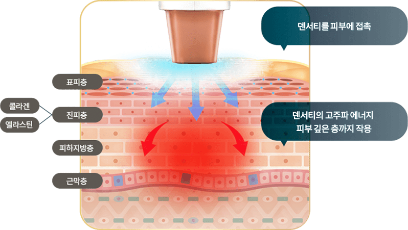 덴서티를 피부에 접촉하여 피부 깊은 층까지 작용