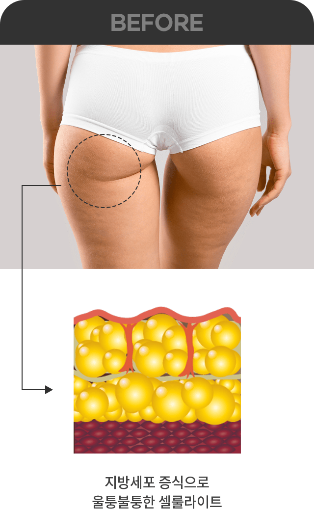 因脂肪细胞增殖凹凸不平的橘皮组织