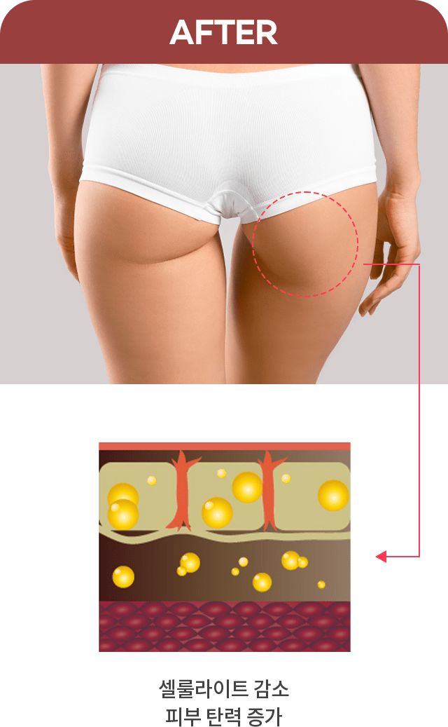 减少橘皮组织增强肌肤弹力